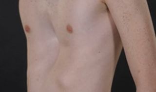 Pectus Excavatum