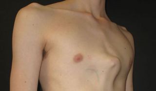 Pectus Carinatum